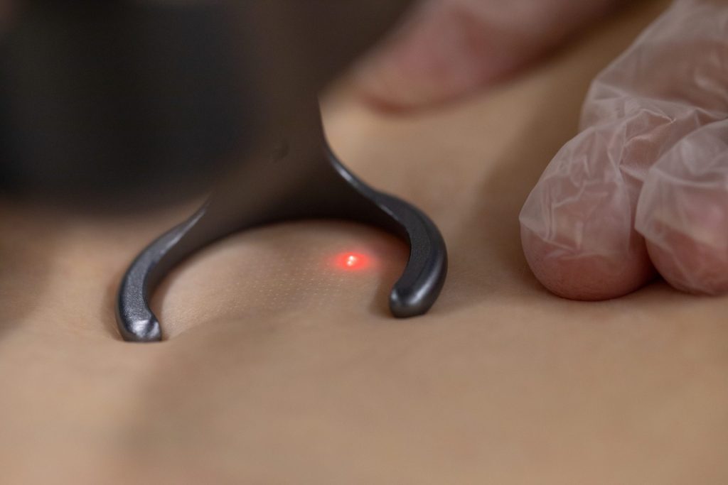 Laser Hair Removal