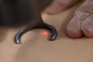 Laser Hair Removal