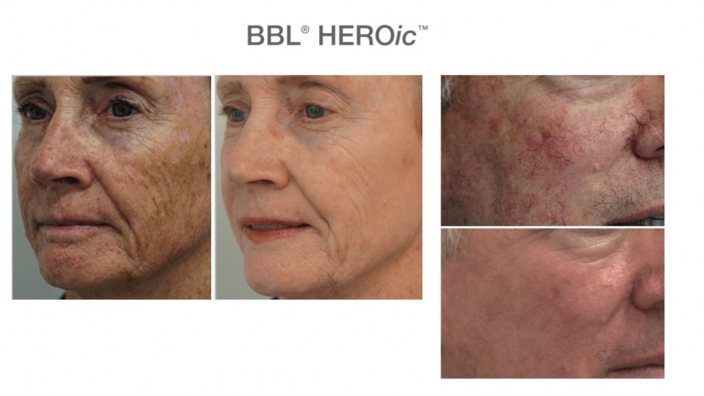 Botox Help Manage Wrinkles