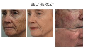 Botox Help Manage Wrinkles
